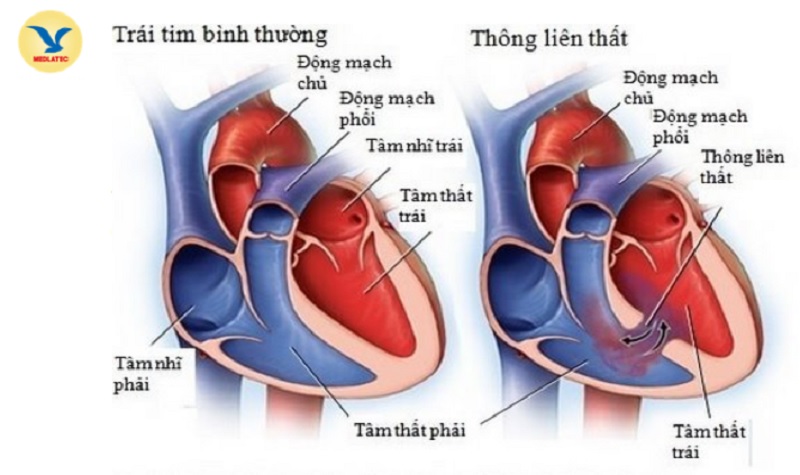 Thông liên thất - một lỗ hở tại vách liên thất của tim