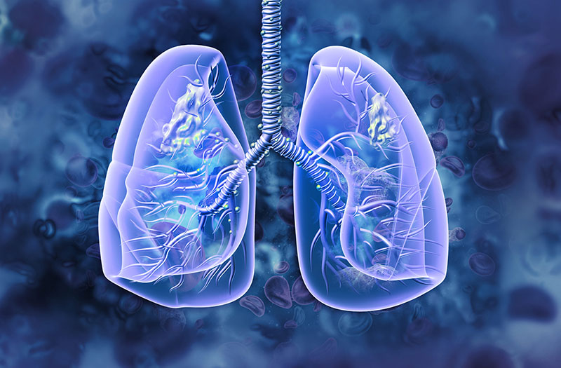 Sự liên quan giữa u phổi di căn não và bệnh ung thư não bạn cần biết