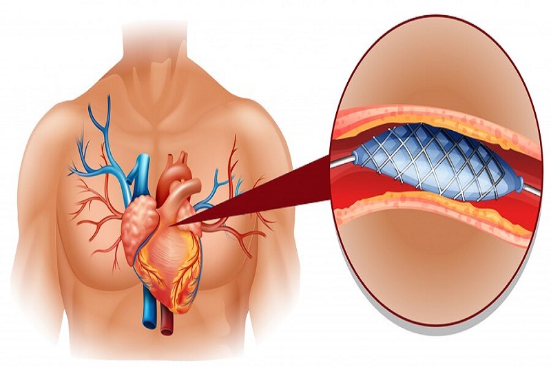 Dụng cụ Stent mạch vành