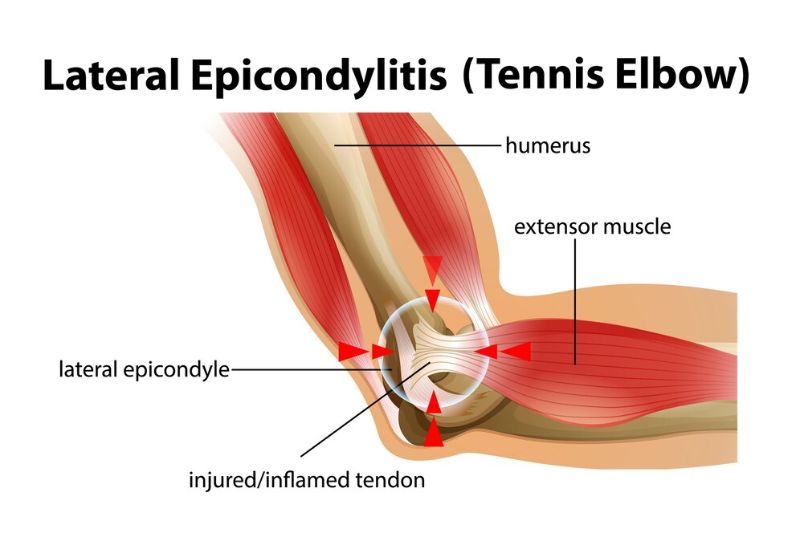 Viêm điểm bám gân lồi cầu ngoài xương cánh tay hay xảy ra ở người chơi thể thao thường xuyên