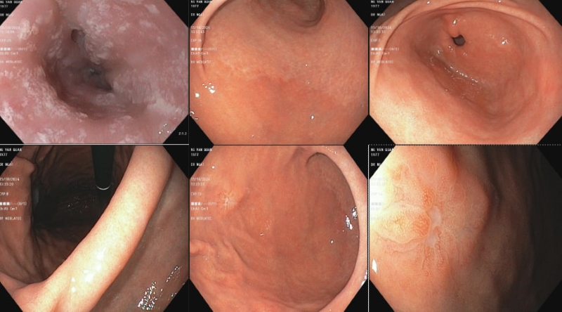 Hình ảnh nội soi tiêu hóa của bệnh nhân phát hiện các dấu hiệu bất thường 