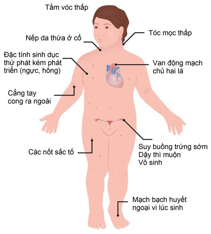 Các đặc điểm chính của hội chứng Turner