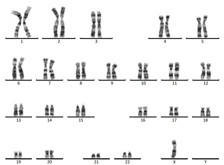 Kiểu nhân (Karyotype) điển hình của hội chứng Turner là 45,X; nghĩa là trong bộ nhiễm sắc thể, ở cặp nhiễm sắc thể giới tính chỉ có một nhiễm sắc thể X