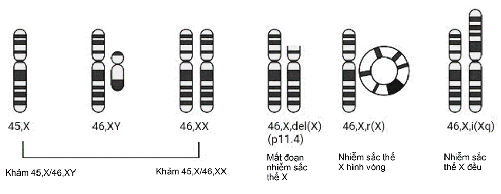 Các dạng bất thường nhiễm sắc thể X gặp trong hội chứng Turner