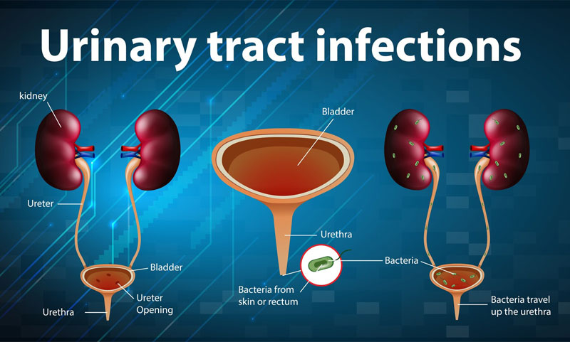 Tình trạng nhiễm khuẩn tiết niệu gây ra bởi vi khuẩn E.coli trong đường ruột