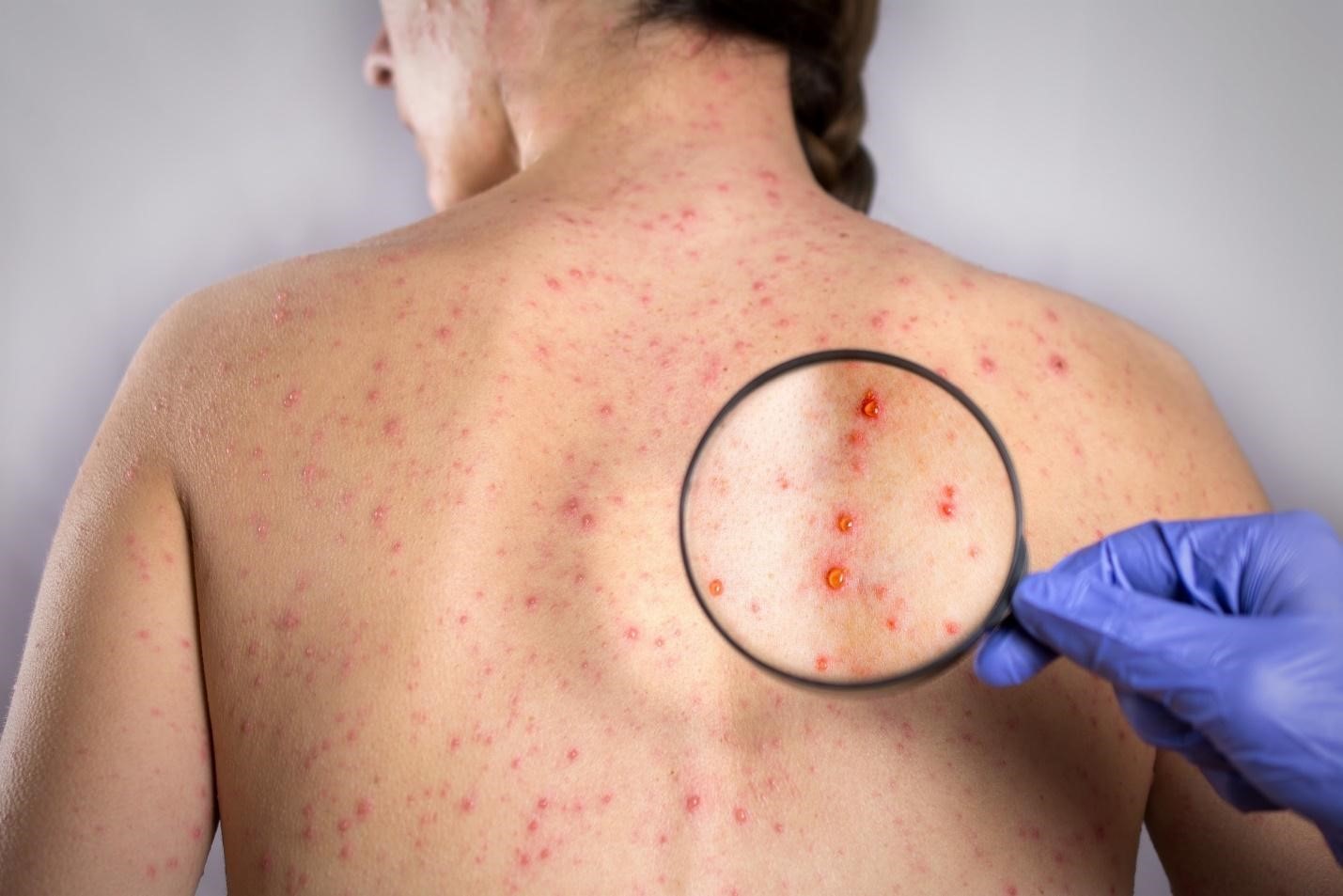 Phát ban đỏ trên bệnh nhân Rubella