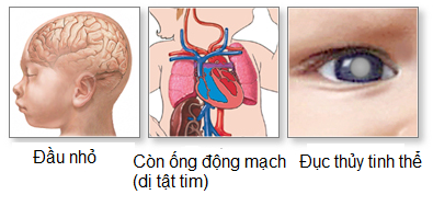 Rubella bẩm sinh