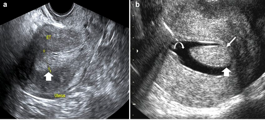 Hình ảnh polyp buồng tử cung - nguyên nhân gây rong kinh được chẩn đoán qua siêu âm đầu dò âm đạo