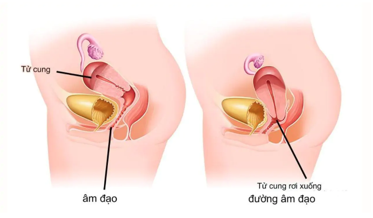 Vị trí sinh lí của tử cung và bệnh lý sa tử cung