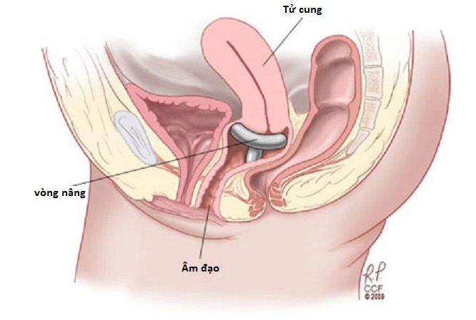 Vòng nâng làm bằng chất liệu silicone có ưu điểm là không gây kích ứng, độ bền cao.