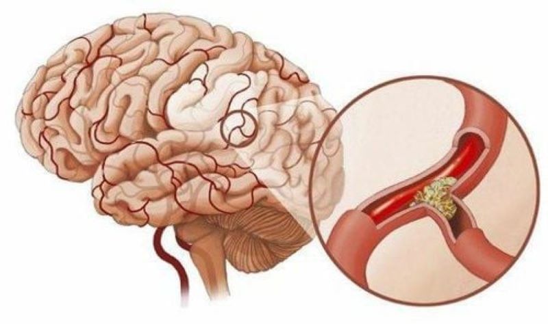 Huyết khối tĩnh mạch não là tình trạng tĩnh mạch não và xoang tĩnh mạch não bị tổn thương do hình thành cục máu đông 