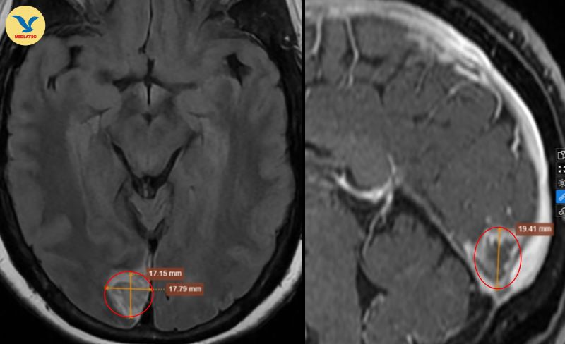 Hình ảnh chụp MRI sọ não của bệnh nhân phát hiện nốt tổn thương vị trí chất xám vỏ não vùng chẩm bên phải 