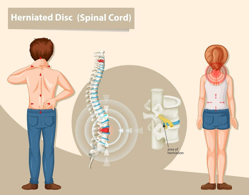 Thoát vị đĩa đệm đốt sống gây chèn ép dây thần kinh dẫn đến tê bì chân tay