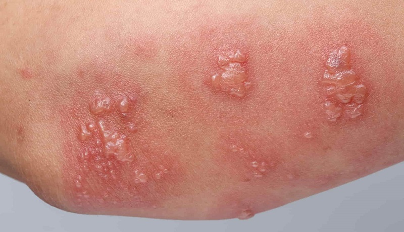 Herpes gây nên những mụn nước đau rát trên da