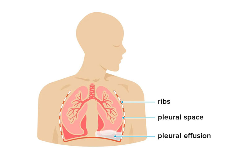 Có bao nhiêu loại dịch màng phổi?
