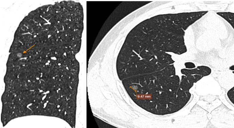 Hình ảnh nốt kính mờ phân thùy S6 phổi phải đường kính 9,5mm, kèm một số nốt rải rác nhu mô hai phổi. 