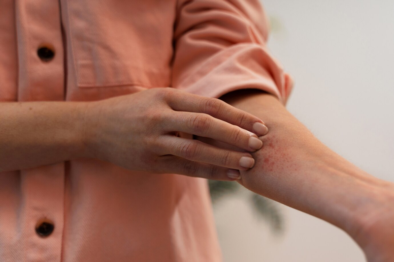 Viêm da dị ứng ở tay chân là tình trạng tay chân ngứa ngáy, có nốt sưng đỏ