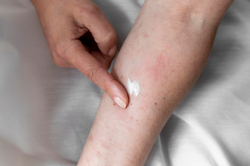Bôi thuốc và kem dưỡng ẩm thường được áp dụng trong điều trị viêm da dị ứng ở tay chân