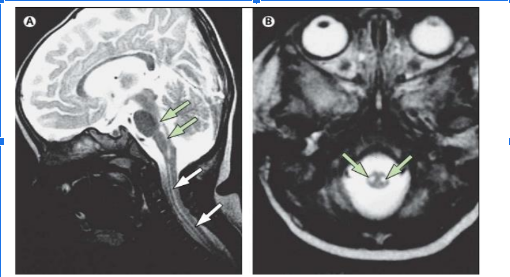 Hình ảnh MRI sọ não Viêm não tủy do EV717.