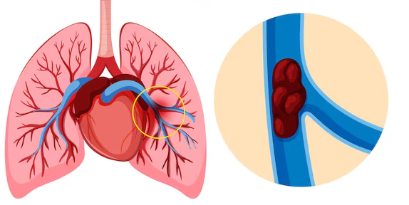 Hình ảnh cục máu đông di chuyển qua tim đến động mạch phổi và gây bít tắc dẫn đến tình trạng thuyên tắc phổi