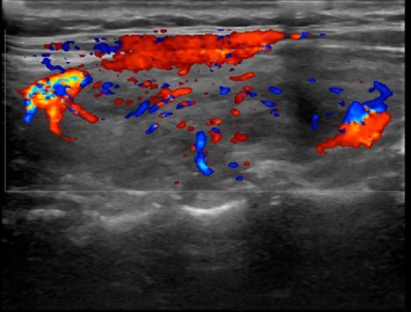 Kết quả siêu âm Doppler màu của bệnh nhân có nhu mô tuyến giáp giảm âm không đồng nhất, tăng sinh mạch 