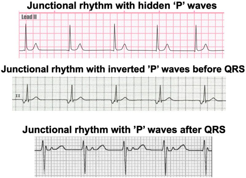 Nhịp bộ nối với sóng P đảo ngược hoặc ẩn trên ECG