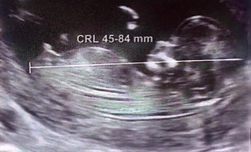 Hình ảnh giúp hình dung chỉ số CRL trong siêu âm thai là gì?