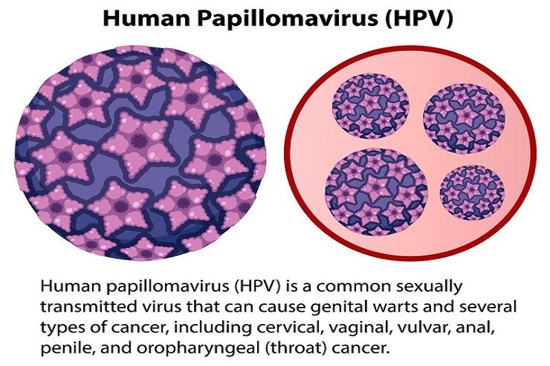 Human Papillomavirus gây nên u nhú sinh dục lành tính dạng mụn nhỏ nhô trên da