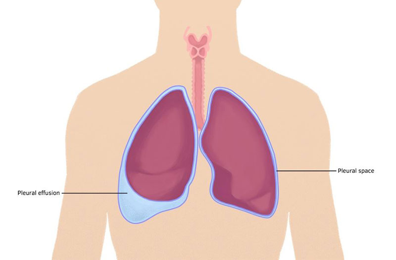 Nguyên nhân gây ra tràn dịch màng phổi là gì?
