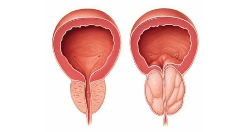 Nang tuyến tiền liệt hình thành do nhiều nguyên nhân 