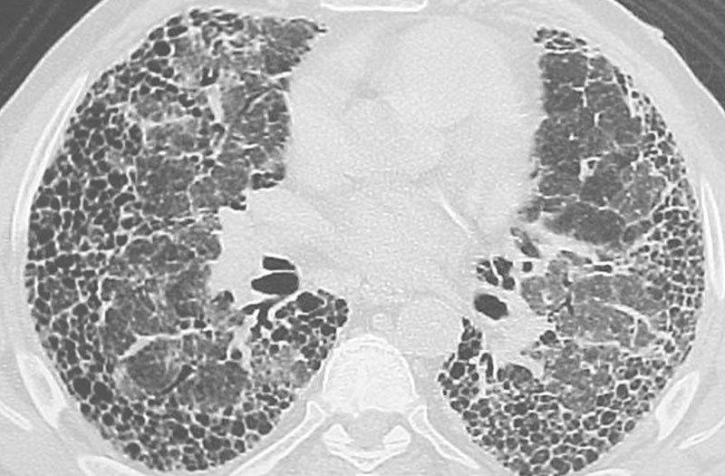 Bệnh xơ 1/3 phổi : Nguyên nhân, dấu hiệu và cách điều trị