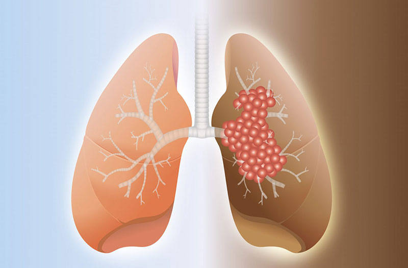 Bệnh gì xảy ra khi vi khuẩn xâm nhập vào phổi?
