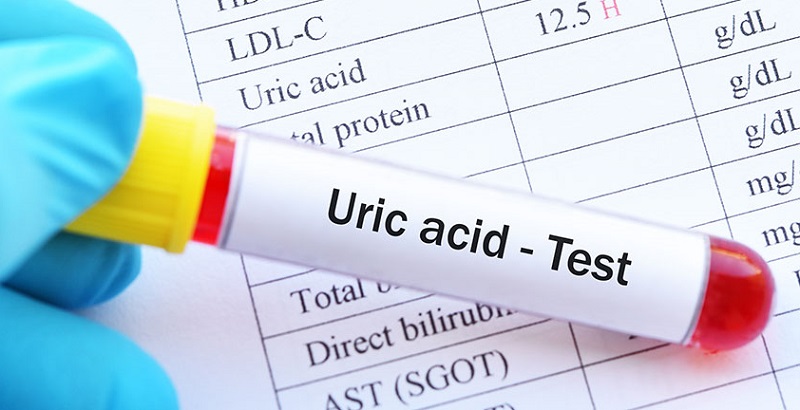 Thông tin tham khảo chỉ số acid uric bao nhiêu thì bị gout