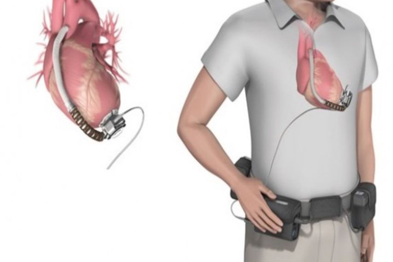 Máy hỗ trợ thất trái LVAD