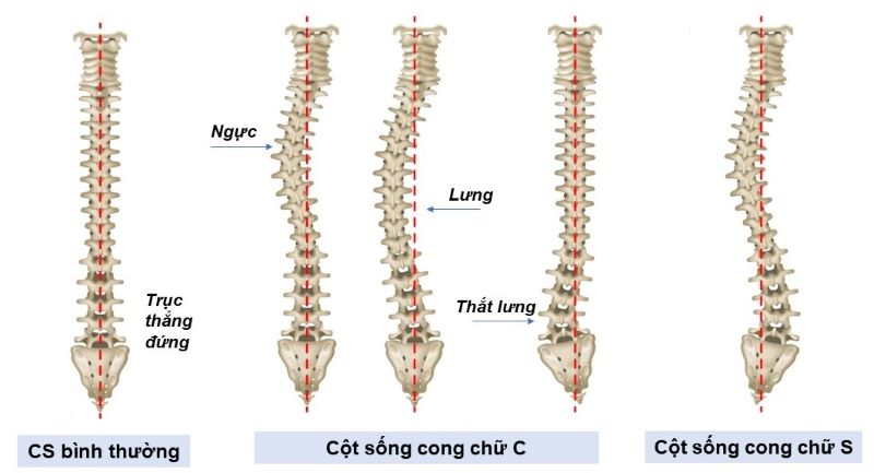 Phân loại vẹo cột sống