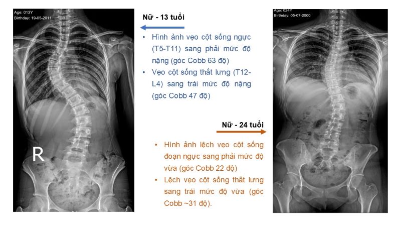 Một số hình ảnh chụp X-quang cột sống tại MEDLATEC