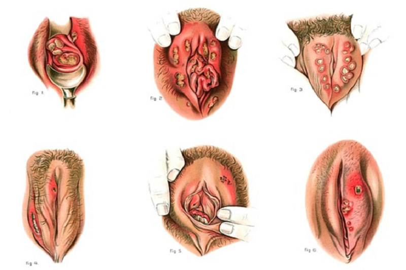 Vết loét đau trên cơ quan sinh dục là một trong những biểu hiện của bệnh hạ cam mềm