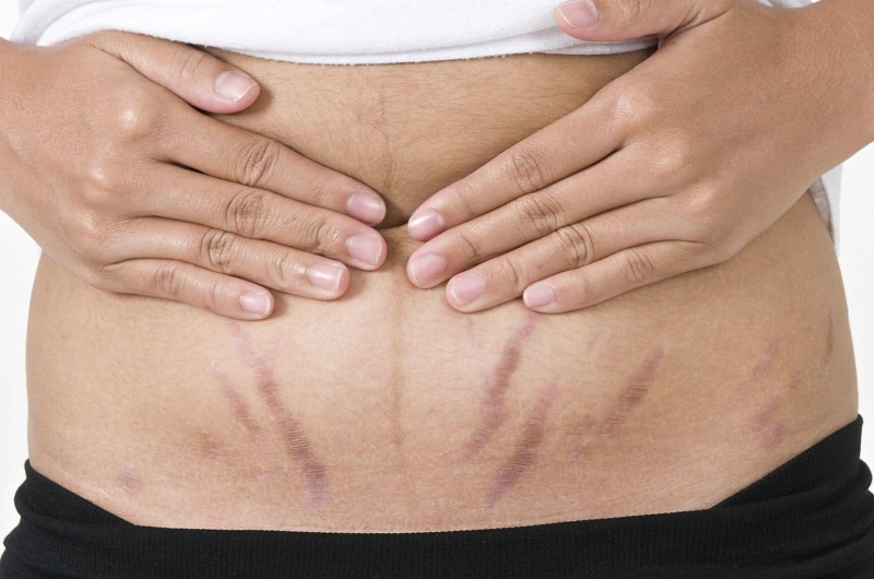 Tại sao bụng rạn sau sinh - Nguyên nhân và cách giảm bụng to