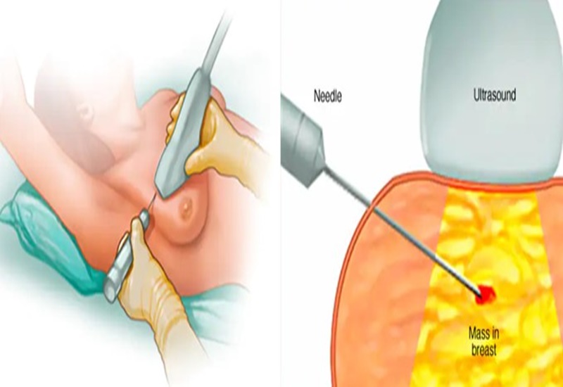 Xét nghiệm sinh thiết: Quy trình và tầm quan trọng trong chẩn đoán y khoa