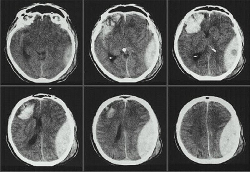 chụp CT sọ não