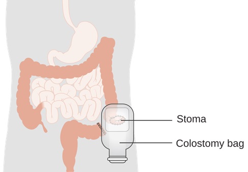 Hậu môn nhân tạo trong điều trị