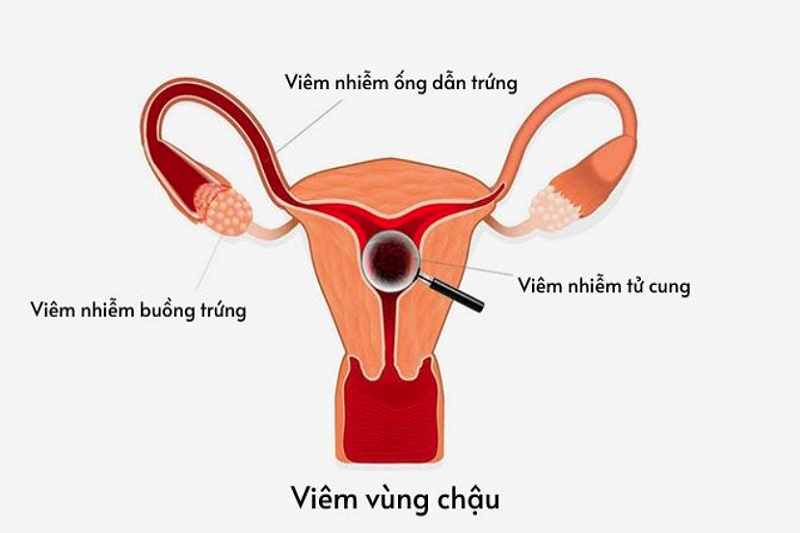 Các cơ quan tổn thương trong viêm vùng chậu