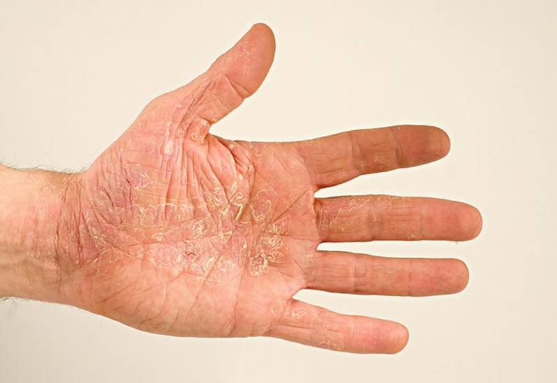 Viêm da tróc vảy là loại viêm da nào và triệu chứng chính của nó là gì?