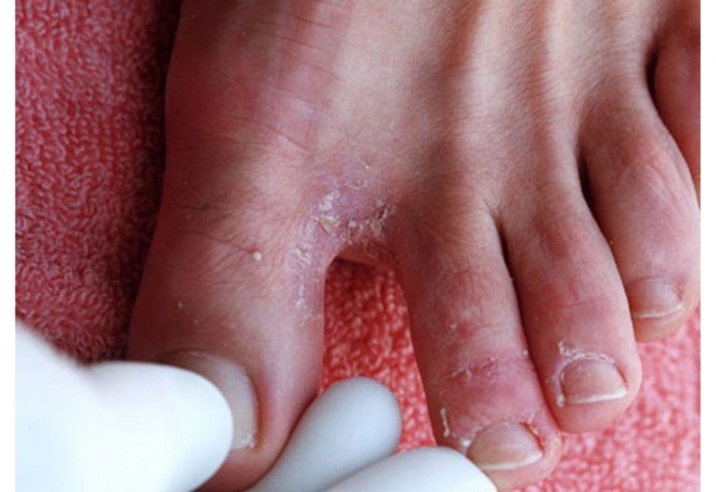 Nguyên nhân và cách điều trị chân bị ngứa tróc da 