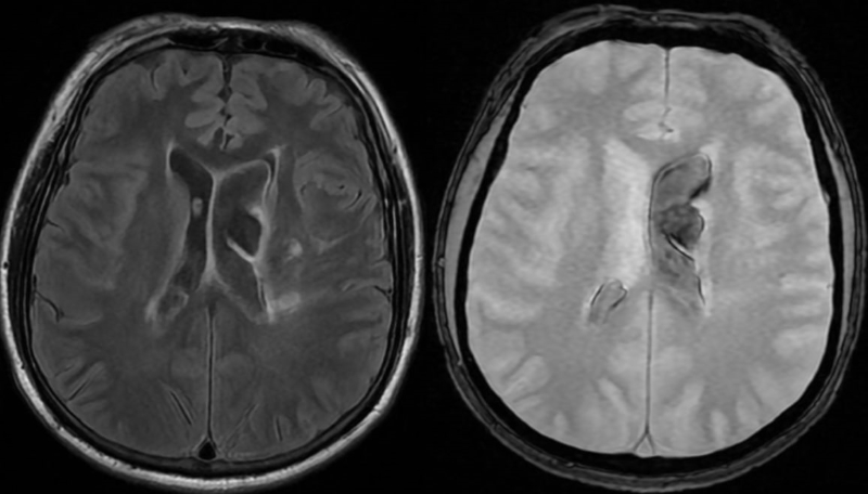 Kết quả chụp MRI phát hiện bất thường 