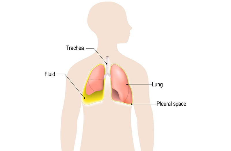 Xuất hiện triệu chứng tràn dịch màng phổi cần thiết phải đến bệnh viện ngay hay có thể tự điều trị tại nhà?
