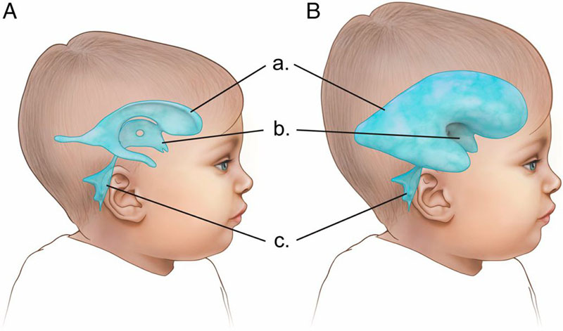 Hình ảnh mô tả bệnh não úng thủy trẻ em