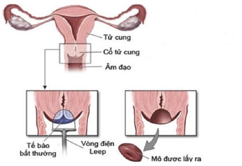LEEP được ưu tiên sử dụng trong các trường hợp tổn thương có thể tiến triển thành ung thư cổ tử cung 