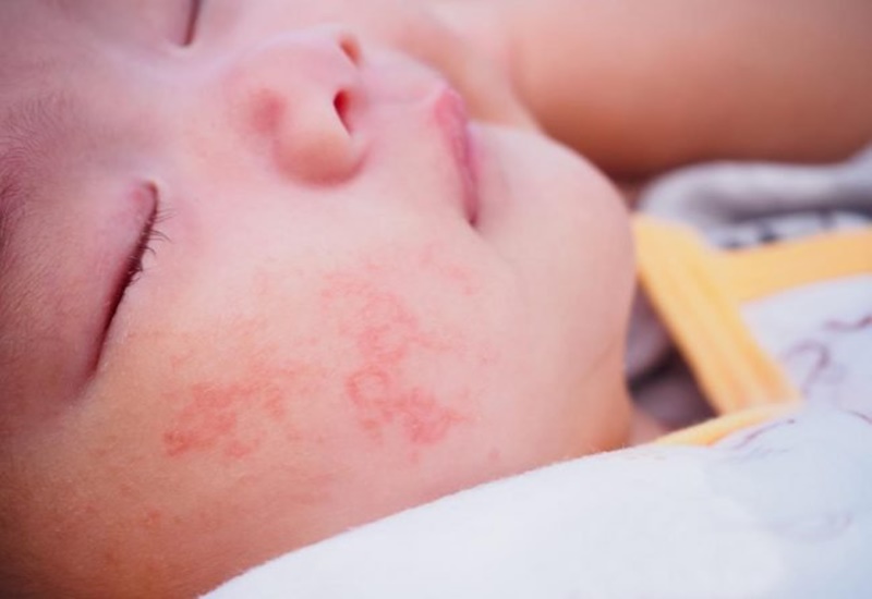  Bé bị viêm da dị ứng : Làm thế nào để chăm sóc da cho bé một cách hiệu quả