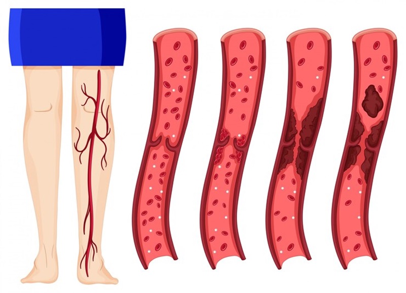 Suy tĩnh mạch chi dưới là do nhiều nguyên nhân khác nhau